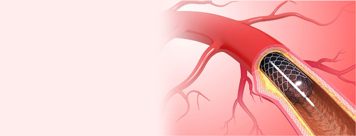 Angioplasty Stent Cost: An Overview